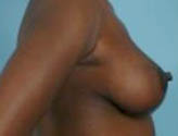 Patient # 12843 After Photo # 6